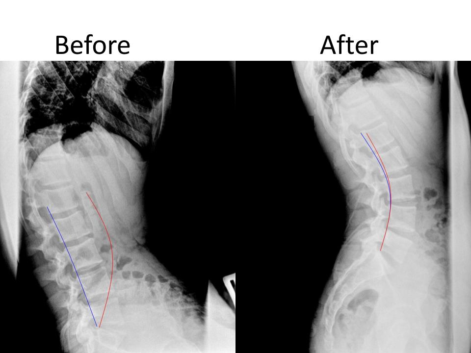 Lumbar (Low Back) Spine Correction