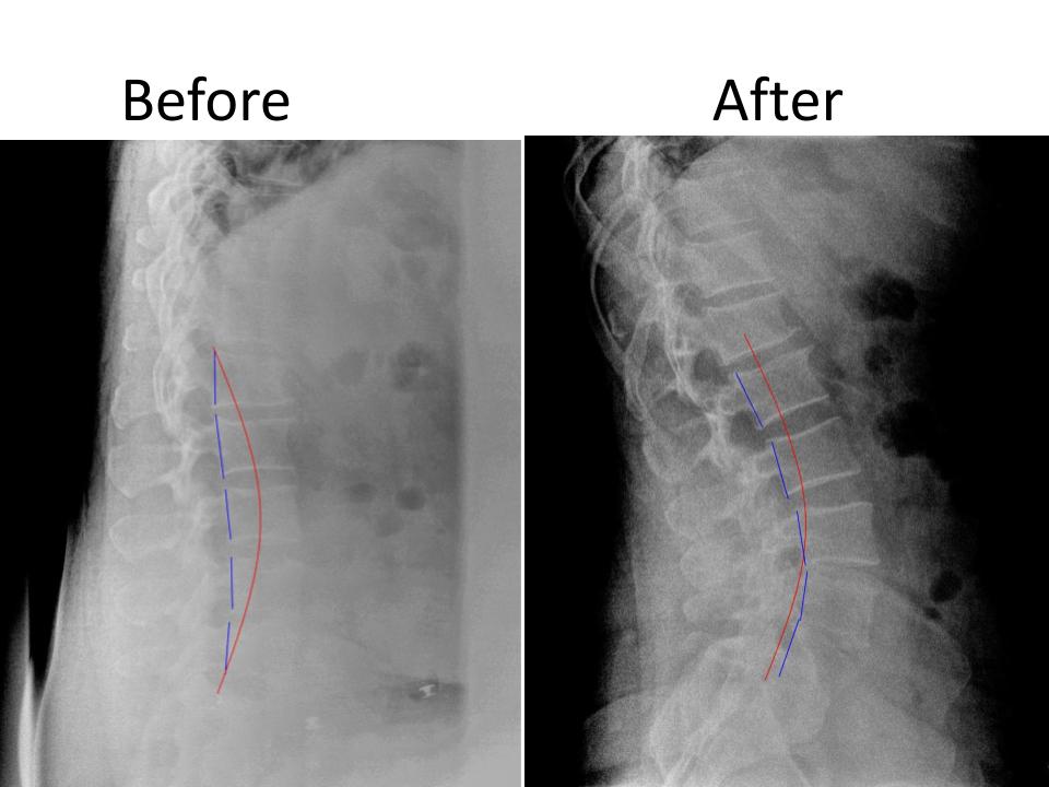 Lumbar (Low Back) Spine Correction
