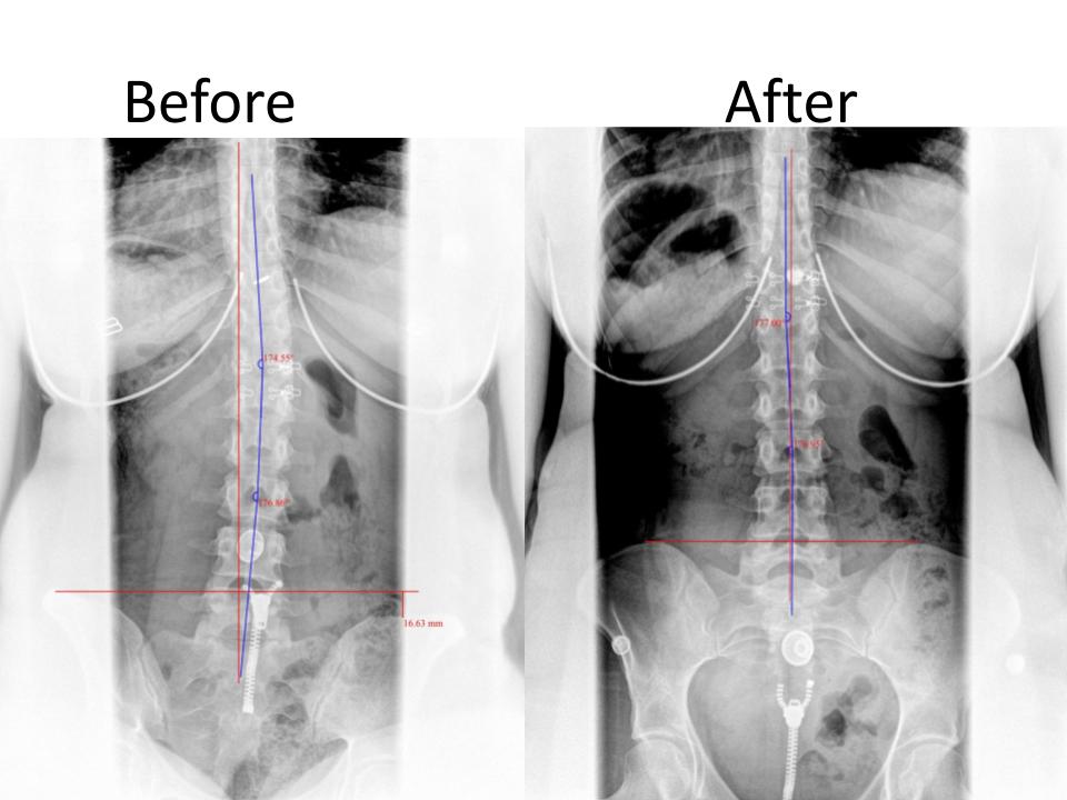 Scoliosis Correction Before & After