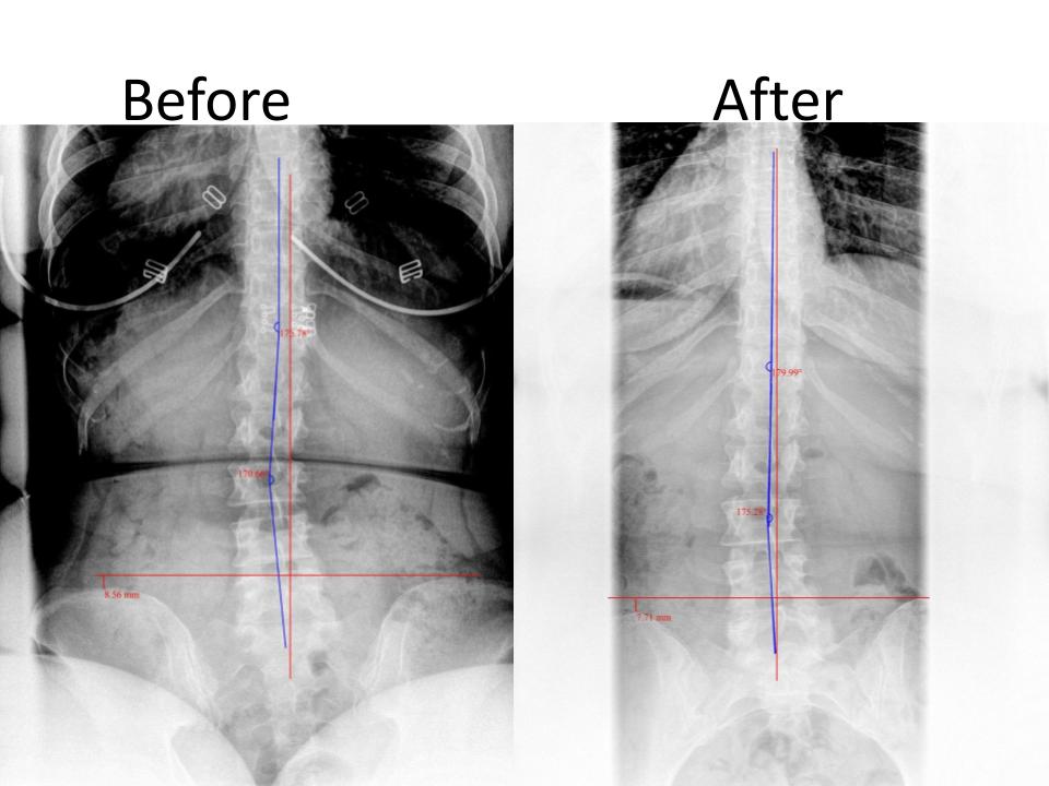 Scoliosis Correction Before & After